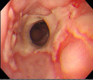 全周性食道潰瘍の画像